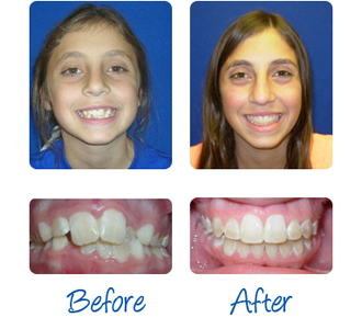 braces before orthodontics mazzei orthodontic patients smiles treatment
